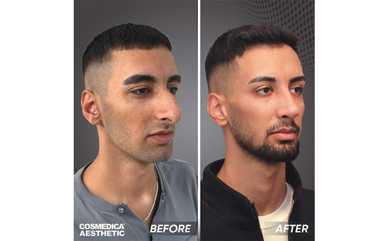 Top 10 Best Rhinoplasty (Nose Job) Surgeon Turkey: 2026 Expert Guide